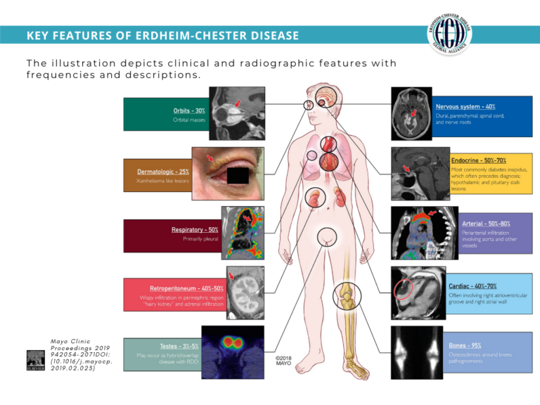 ErdheimChester Disease Global Alliance
