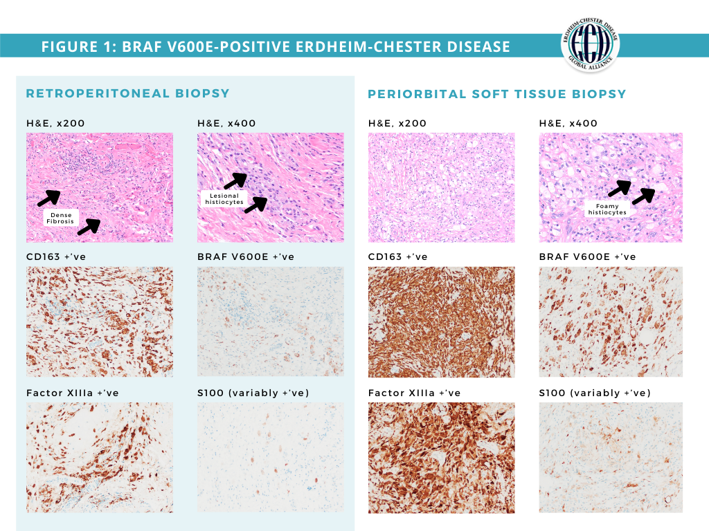 ErdheimChester Disease Global Alliance