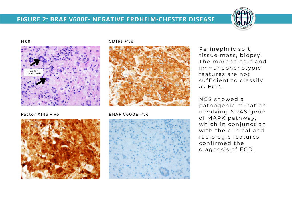 ErdheimChester Disease Global Alliance